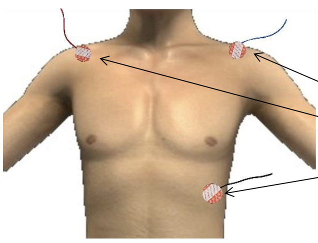 Firmly scrub the following locations using an alcohol prep.</p>
<p>End of collar bone (clavicle) near left shoulder.<br />
End of collar bone (clavicle) near right shoulder.<br />
On lower left rib.</p>
<p>Now attach a self-adhesive electrode to each location. Place a 1 1⁄2 to 2 inch piece of cloth tape over each electrode for added security if desired. It is unlikely these will become dislodged.