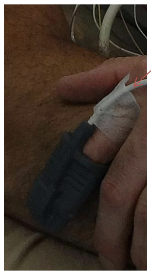 Figure 11</p>
<p>Figure 12</p>
<p>Place your finger in the Flexible SPO2<br />
probe. Use cloth tape on the finger<br />
to hold it in place.<br />
Note: Finger nail polish can interfere<br />
with the reading.